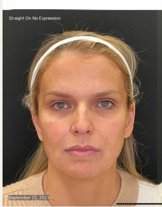 Before photo — Patient B