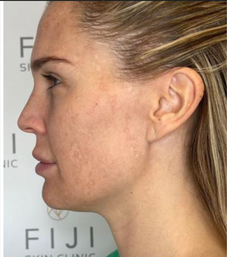 Before photo — Patient A