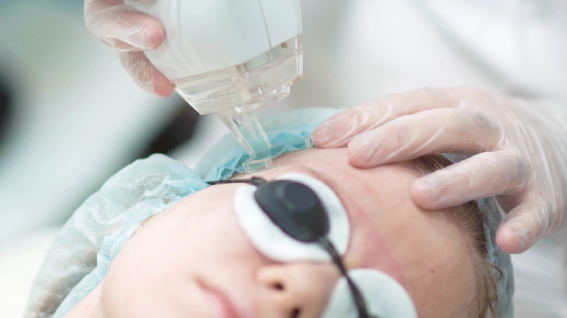 IPL photofacial treatment