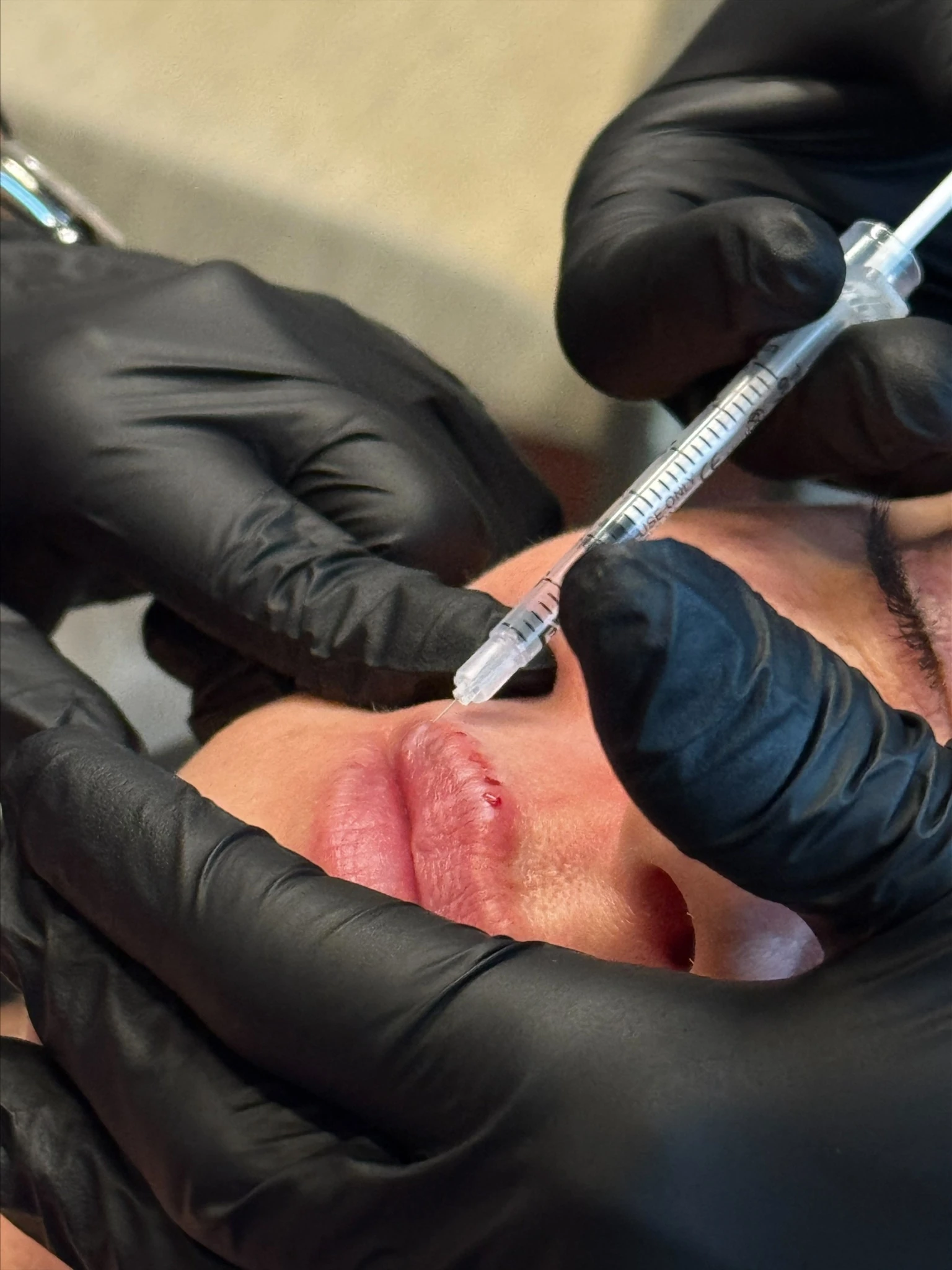 Dermal filler treatment
