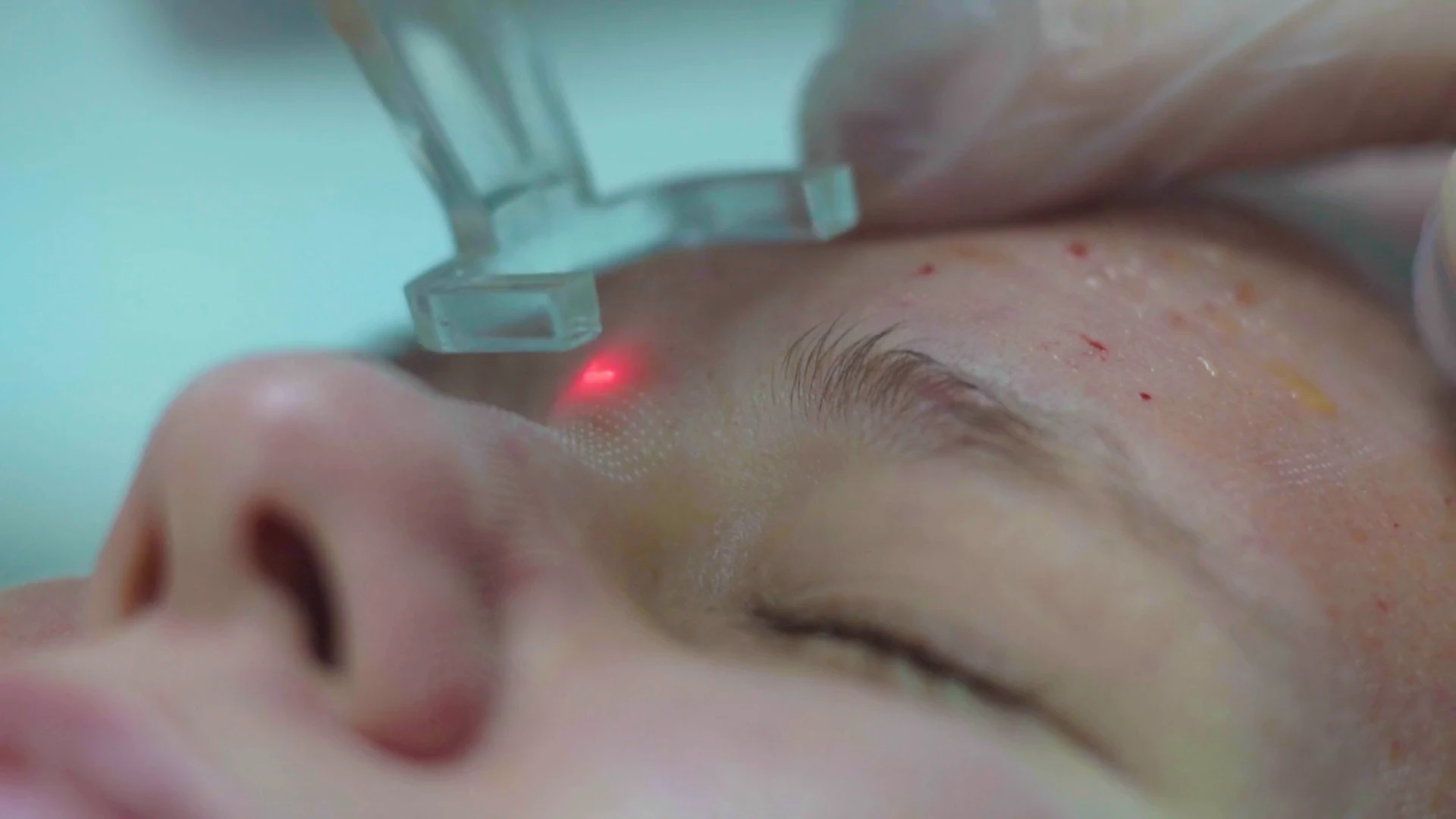 Laser hair removal treatment