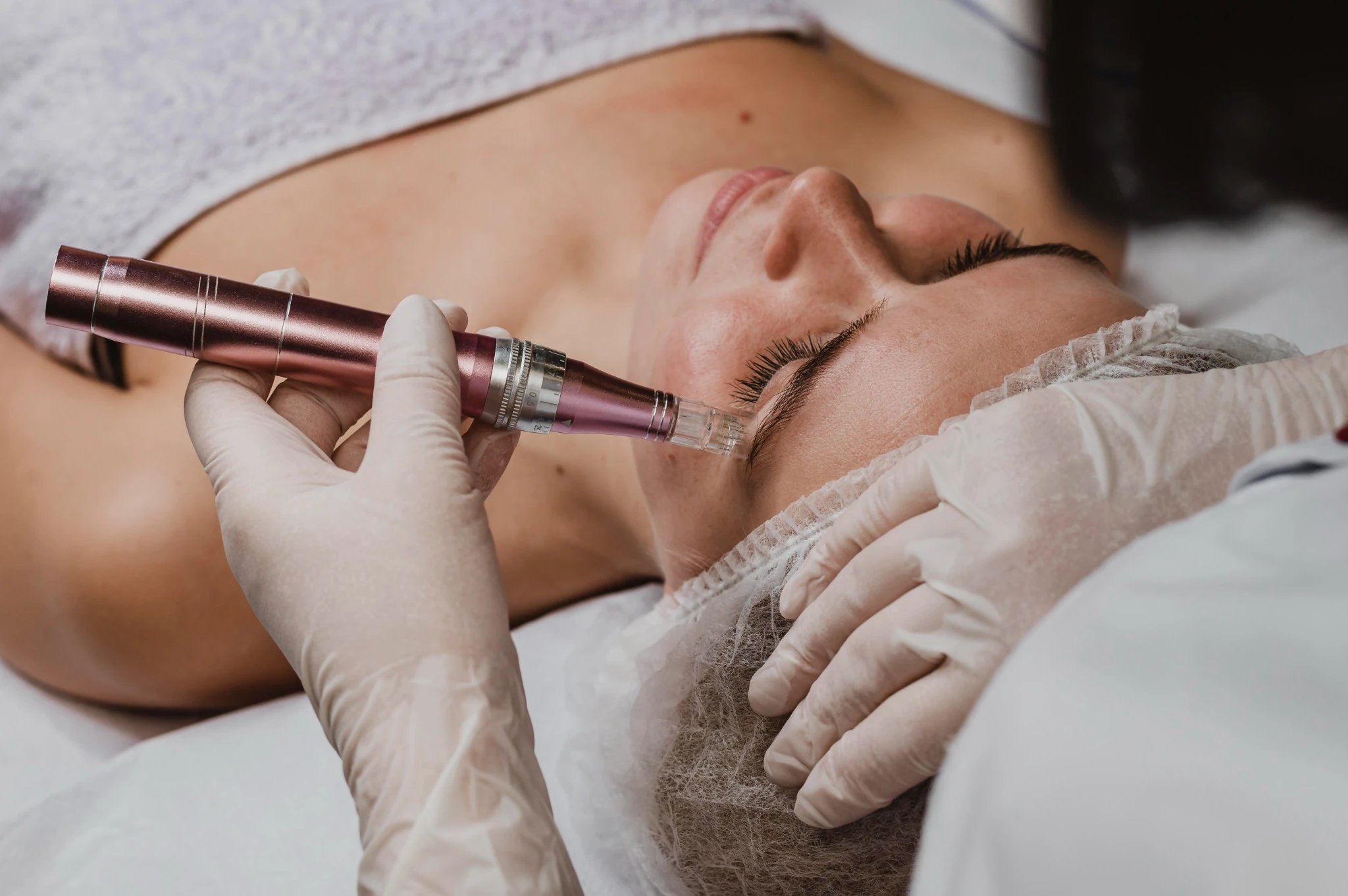 Microneedling treatment